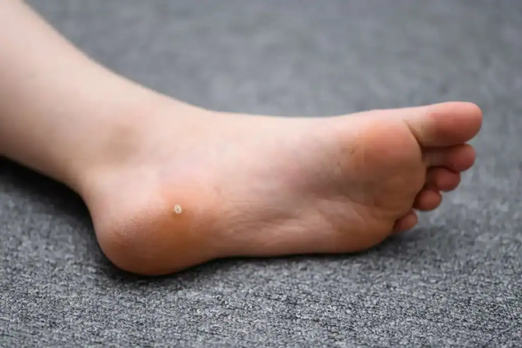 Cryotherapy For Warts And Also Verrucas 2 Image of verruca on the bottom of the foot that able to be treated with Cryotherapy Cardiff