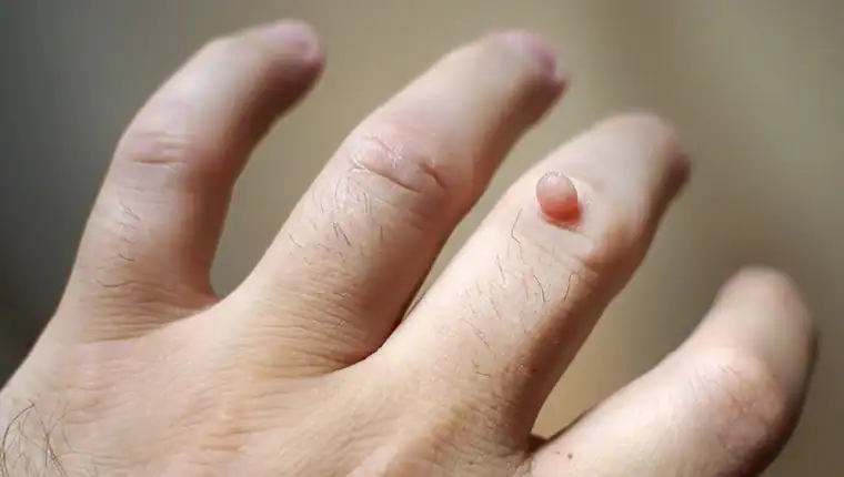 Image of blemish that Cryotherapy Cardiff can remove with Lipo 360.