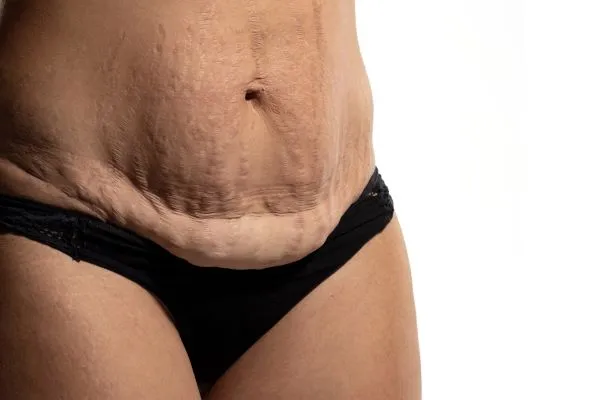 The science behind skin tightening Cardiff picture of a woman's sagging skin on the stomach